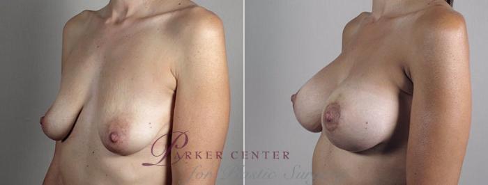 Breast Lift with Implants Case 494 Before & After View #2 | Paramus, NJ | Parker Center for Plastic Surgery