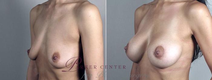 Breast Lift with Implants Case 495 Before & After View #2 | Paramus, NJ | Parker Center for Plastic Surgery
