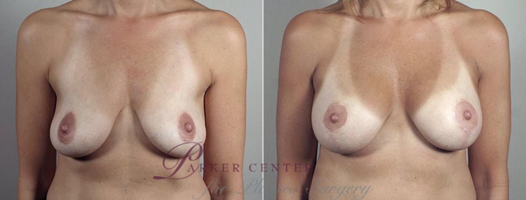 Breast Lift with Implants Case 497 Before & After View #1 | Paramus, NJ | Parker Center for Plastic Surgery