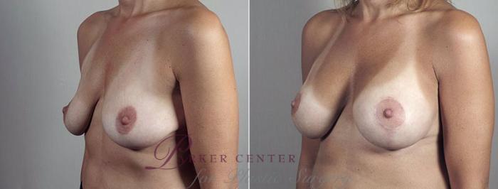 Breast Lift with Implants Case 497 Before & After View #2 | Paramus, NJ | Parker Center for Plastic Surgery
