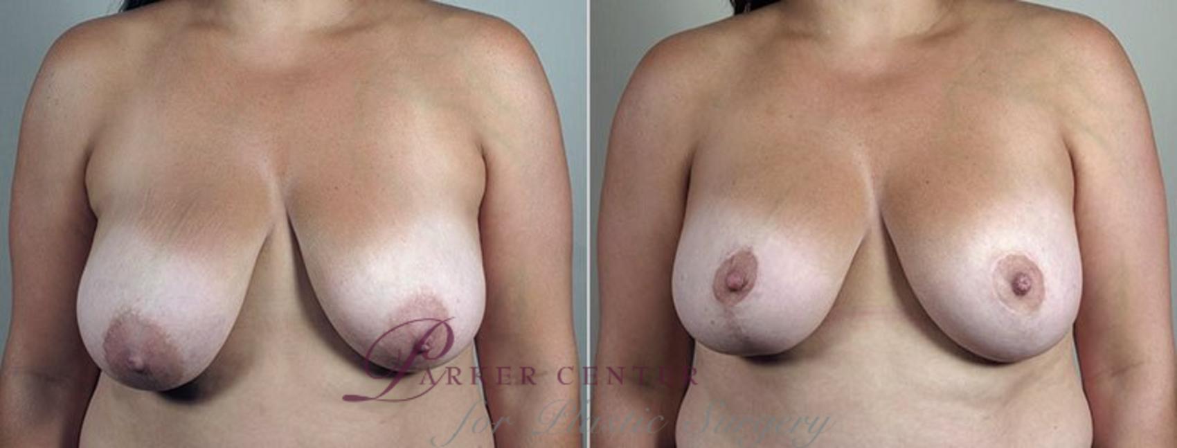 Breast Lift with Implants Case 498 Before & After View #1 | Paramus, NJ | Parker Center for Plastic Surgery