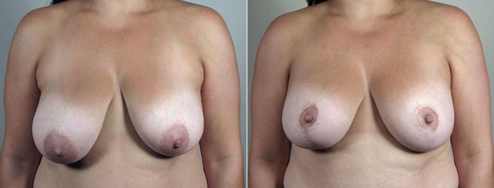 Breast Lift with Implants Case 498 Before & After View #1 | Paramus, New Jersey | Parker Center for Plastic Surgery