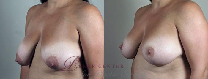Breast Lift with Implants Case 498 Before & After View #2 | Paramus, NJ | Parker Center for Plastic Surgery