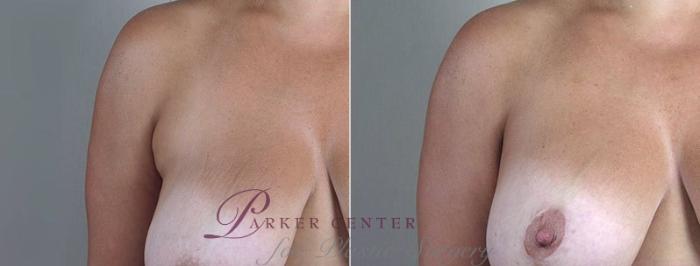 Breast Lift with Implants Case 498 Before & After View #3 | Paramus, NJ | Parker Center for Plastic Surgery