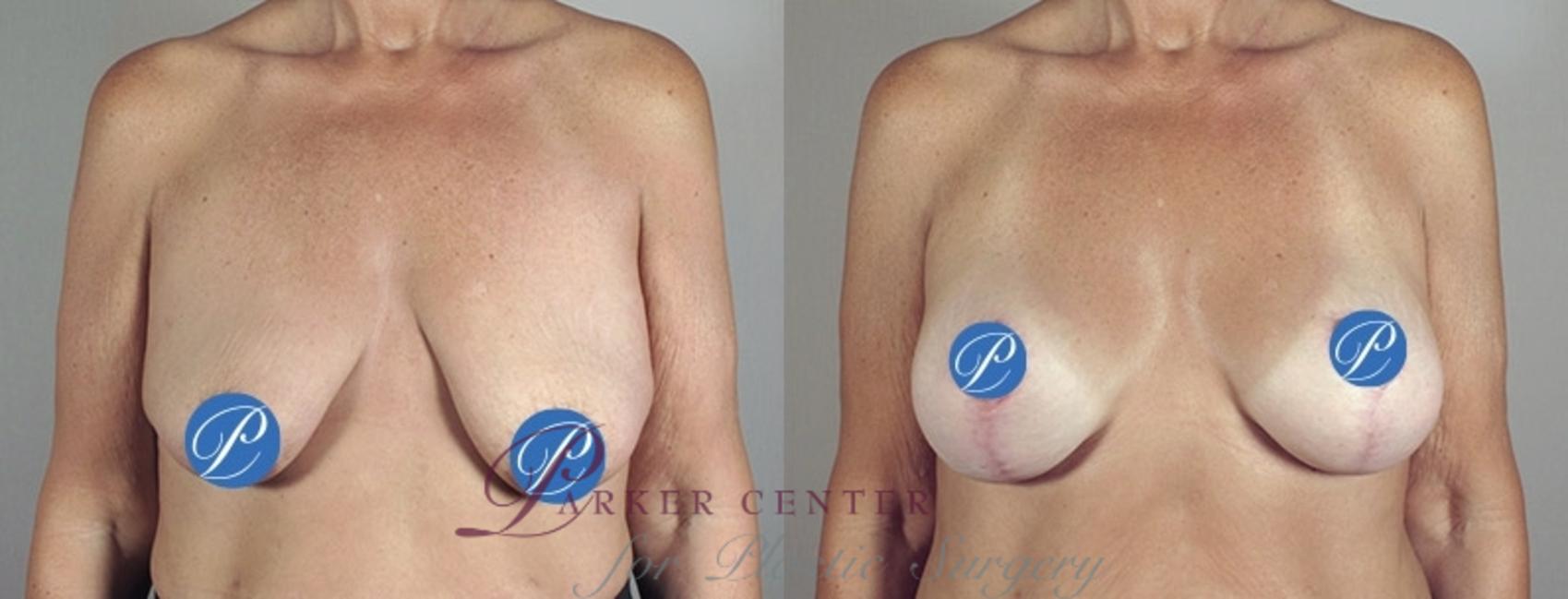 Breast Lift with Implants Case 898 Before & After View #4 | Paramus, NJ | Parker Center for Plastic Surgery