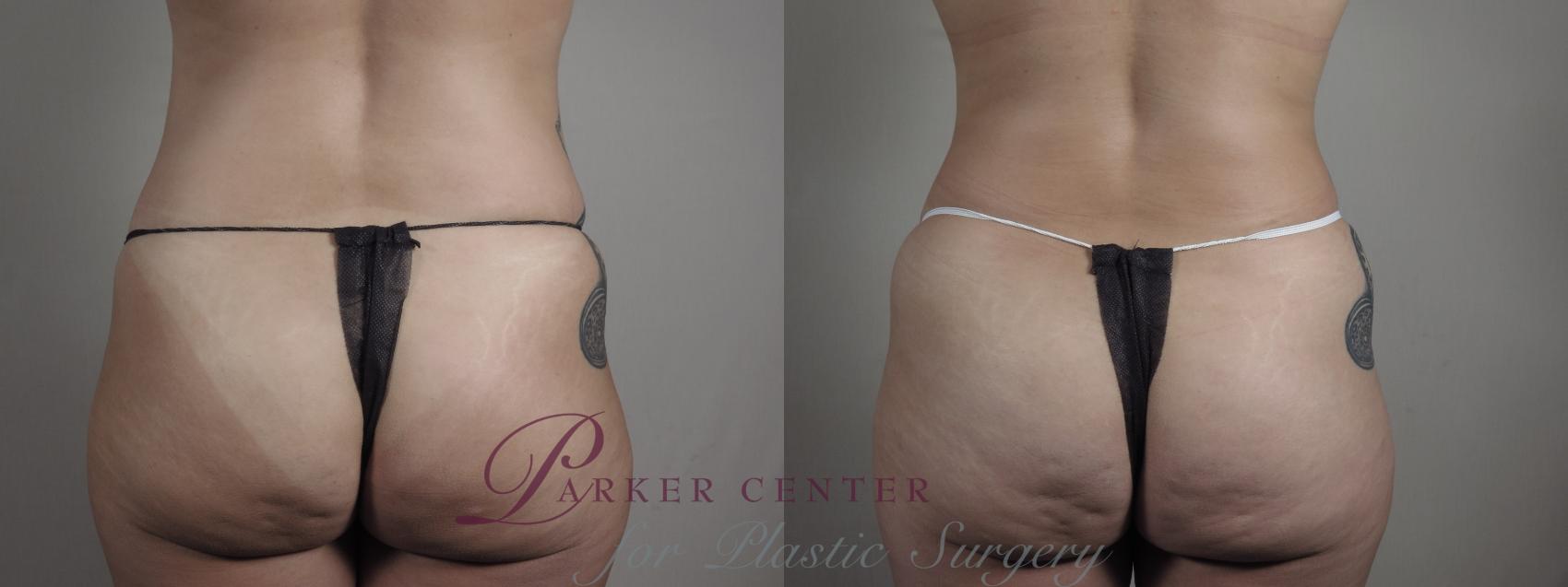Breast Lift with Implants Case 975 Before & After Back | Paramus, NJ | Parker Center for Plastic Surgery