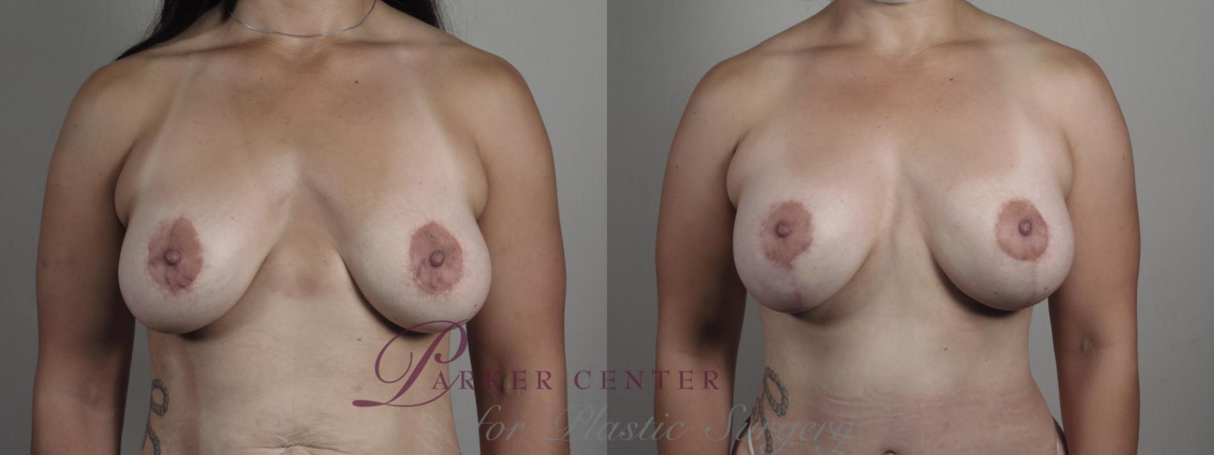 Breast Lift with Implants Case 975 Before & After front b view | Paramus, NJ | Parker Center for Plastic Surgery
