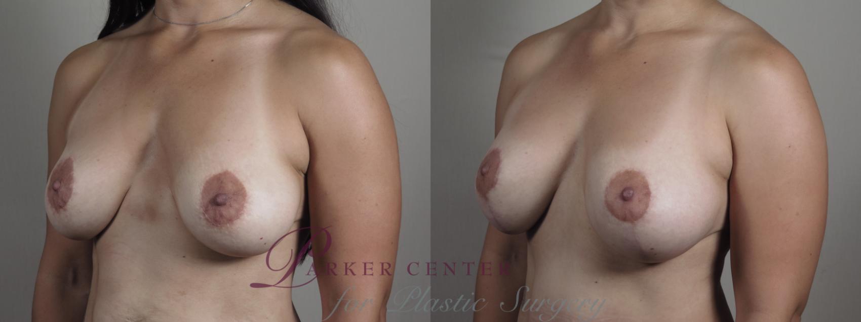 Tummy Tuck Case 975 Before & After right 3/4 b view 2 | Paramus, NJ | Parker Center for Plastic Surgery
