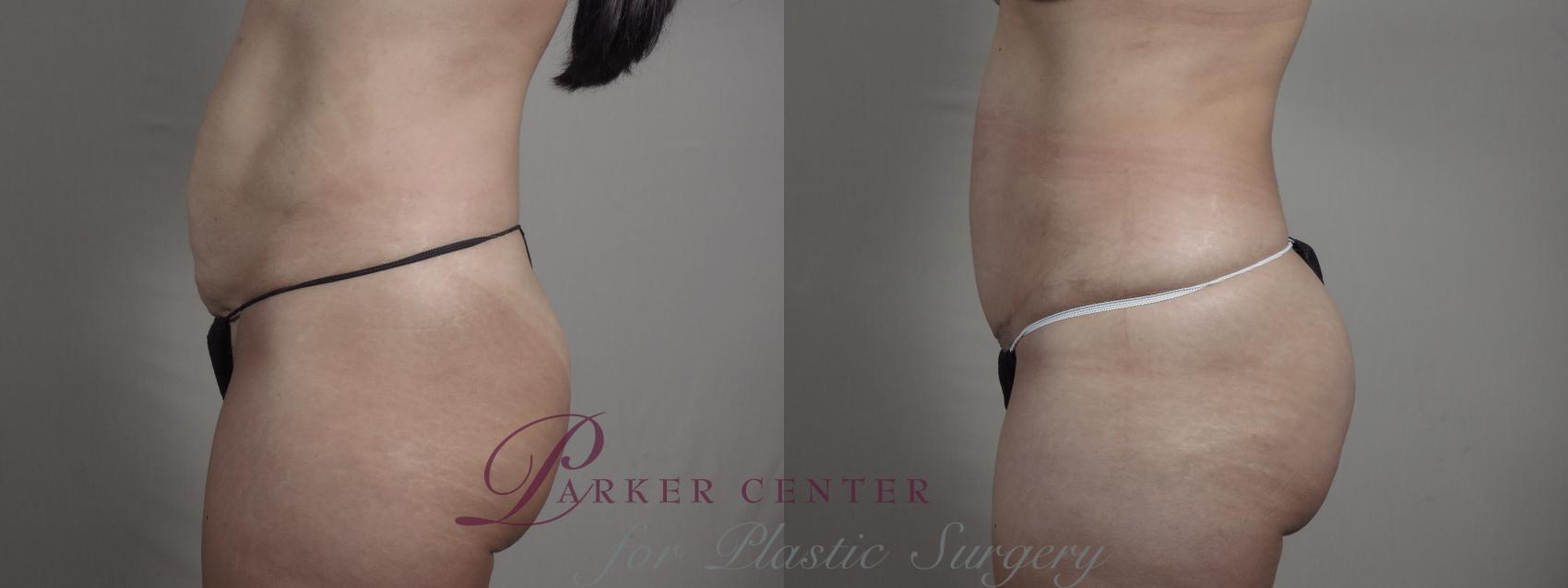 Breast Lift with Implants Case 975 Before & After Right Side | Paramus, NJ | Parker Center for Plastic Surgery