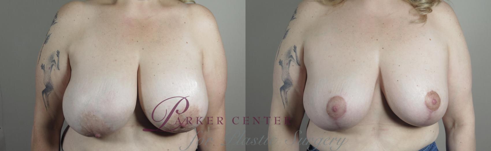 Breast Implant Revision Case 982 Before & After Front | Paramus, NJ | Parker Center for Plastic Surgery
