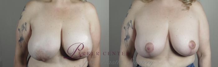 Breast Lift with Implants Case 982 Before & After Front | Paramus, NJ | Parker Center for Plastic Surgery