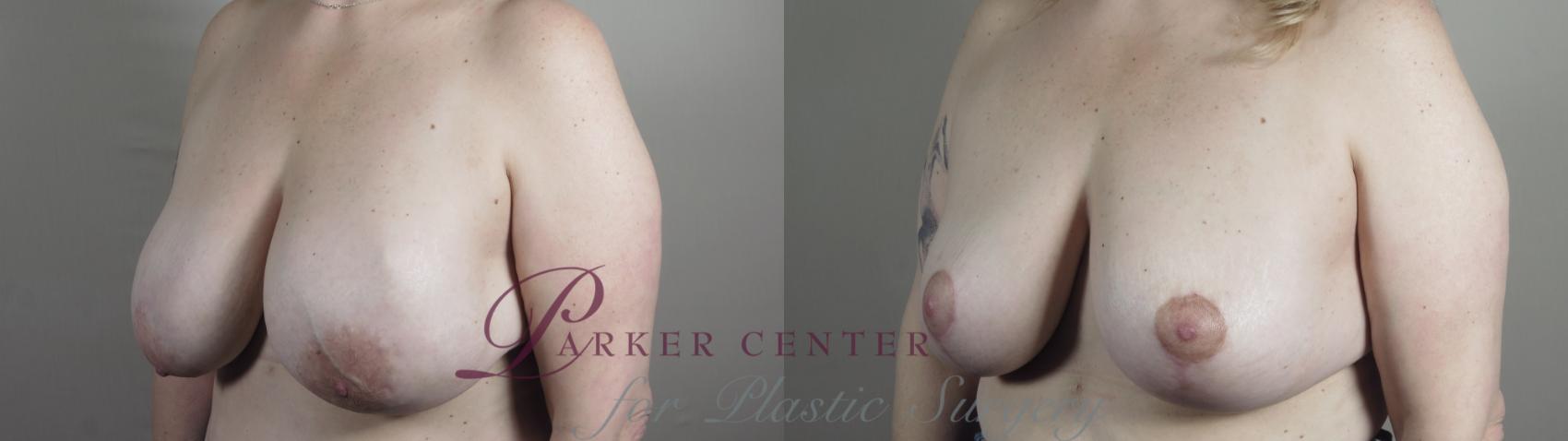 Breast Implant Revision Case 982 Before & After Right Oblique | Paramus, NJ | Parker Center for Plastic Surgery