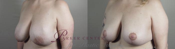 Breast Lift with Implants Case 982 Before & After Right Oblique | Paramus, NJ | Parker Center for Plastic Surgery