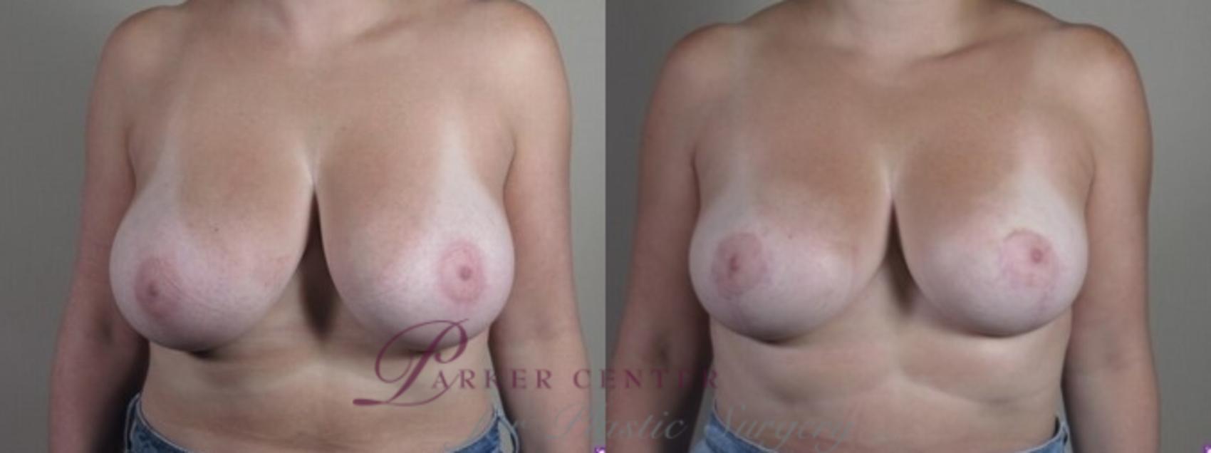 Breast Reduction Case 1252 Before & After Front | Paramus, NJ | Parker Center for Plastic Surgery