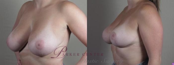 Breast Reduction Case 1252 Before & After Left Oblique | Paramus, NJ | Parker Center for Plastic Surgery