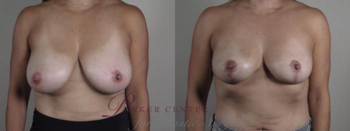 Breast Reduction Case 1328 Before & After Front | Paramus, NJ | Parker Center for Plastic Surgery