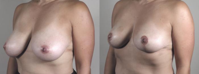 Breast Reduction Case 1328 Before & After Left Oblique | Paramus, New Jersey | Parker Center for Plastic Surgery