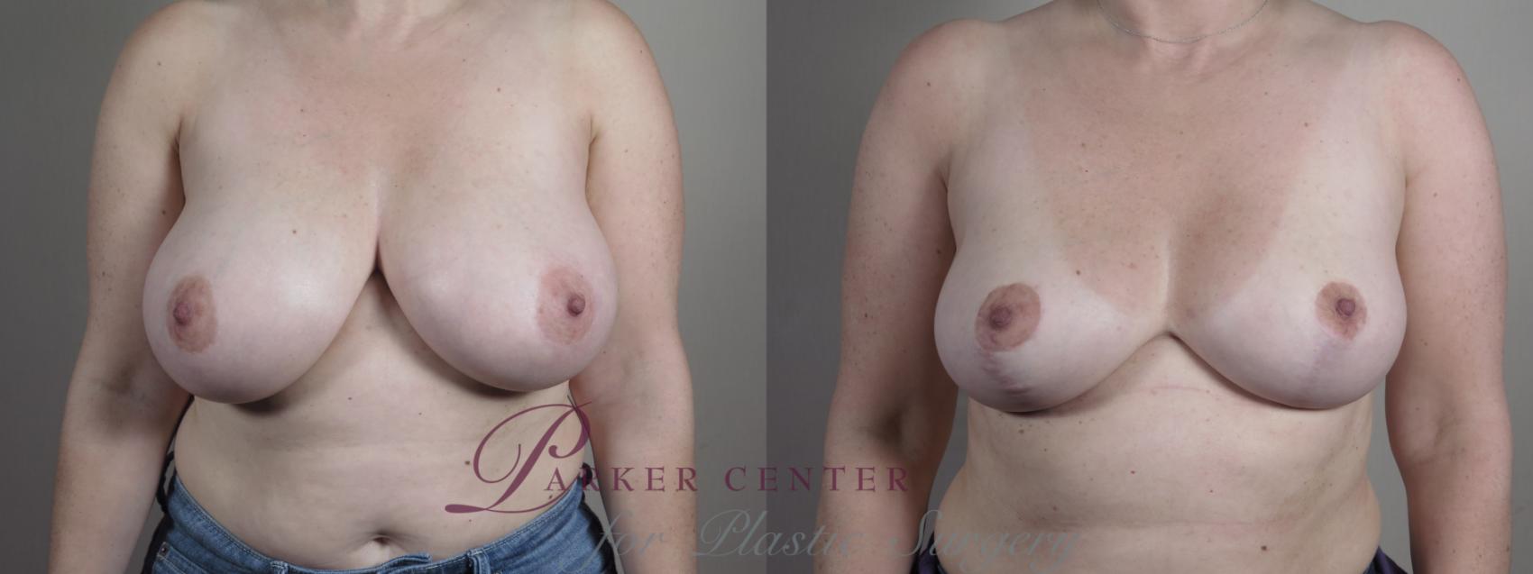 Breast Reduction Case 1329 Before & After Front | Paramus, NJ | Parker Center for Plastic Surgery