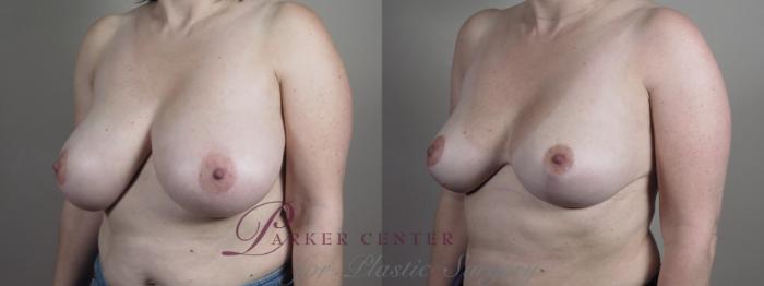Breast Reduction Case 1329 Before & After Left Oblique | Paramus, NJ | Parker Center for Plastic Surgery