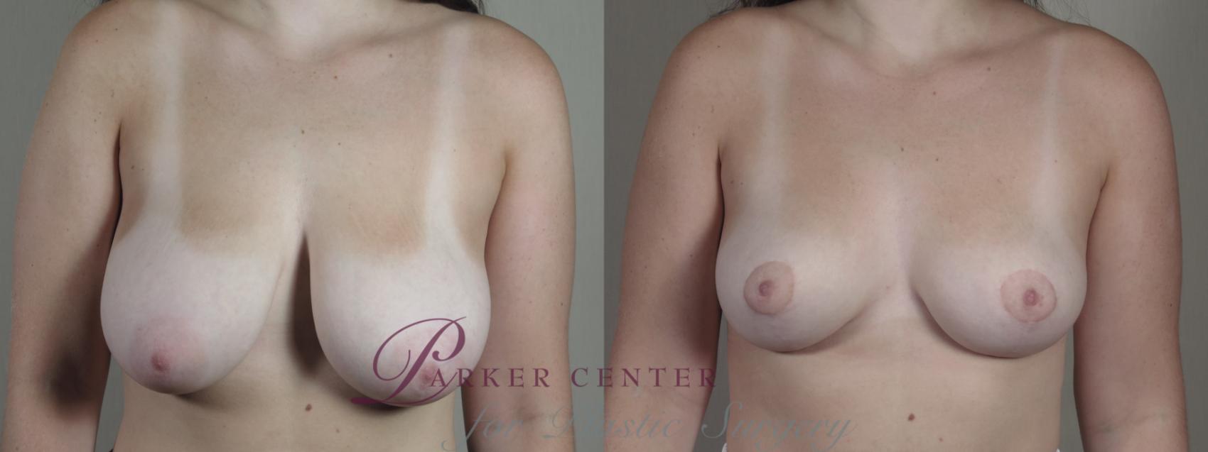 Breast Reduction Case 1331 Before & After Front | Paramus, NJ | Parker Center for Plastic Surgery