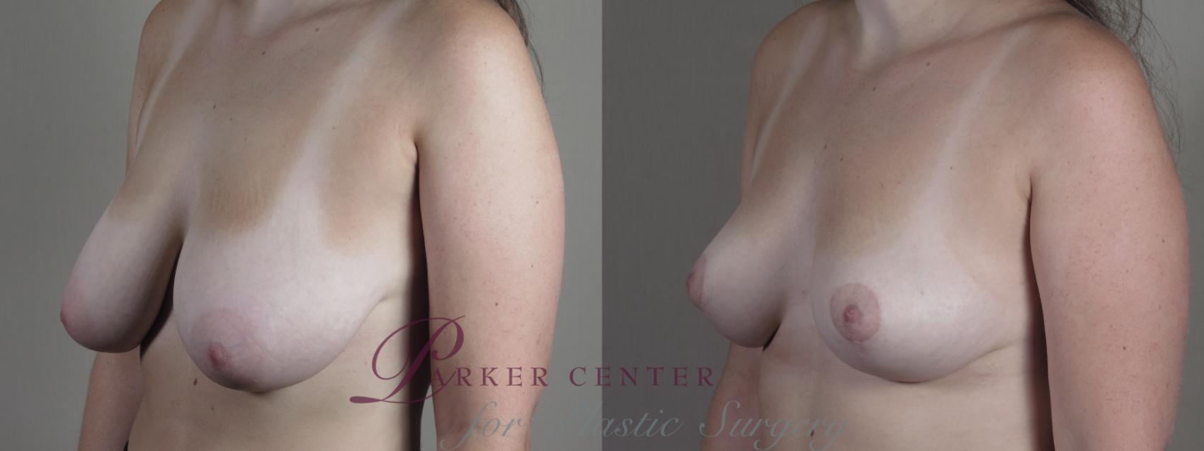 Breast Reduction Case 1331 Before & After Left Oblique | Paramus, New Jersey | Parker Center for Plastic Surgery