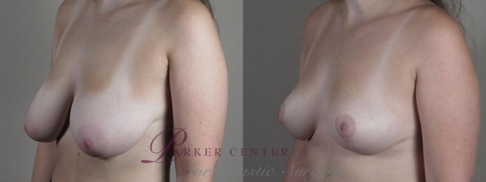 Breast Reduction Case 1331 Before & After Left Oblique | Paramus, NJ | Parker Center for Plastic Surgery