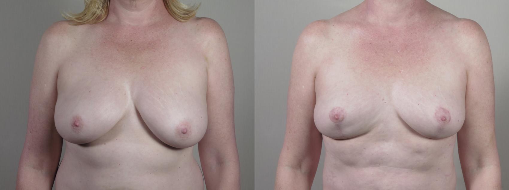 Breast Reduction Case 1427 Before & After Front | Paramus, New Jersey | Parker Center for Plastic Surgery