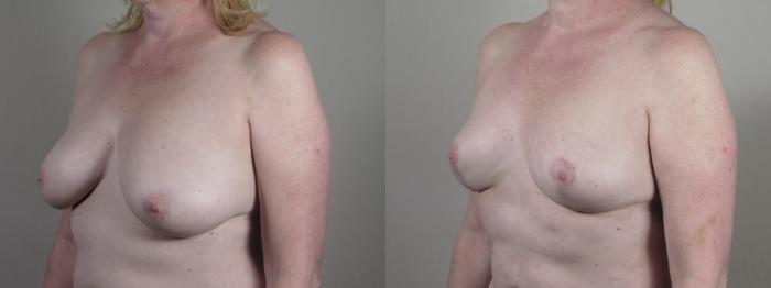 Breast Reduction Case 1427 Before & After Side view | Paramus, New Jersey | Parker Center for Plastic Surgery