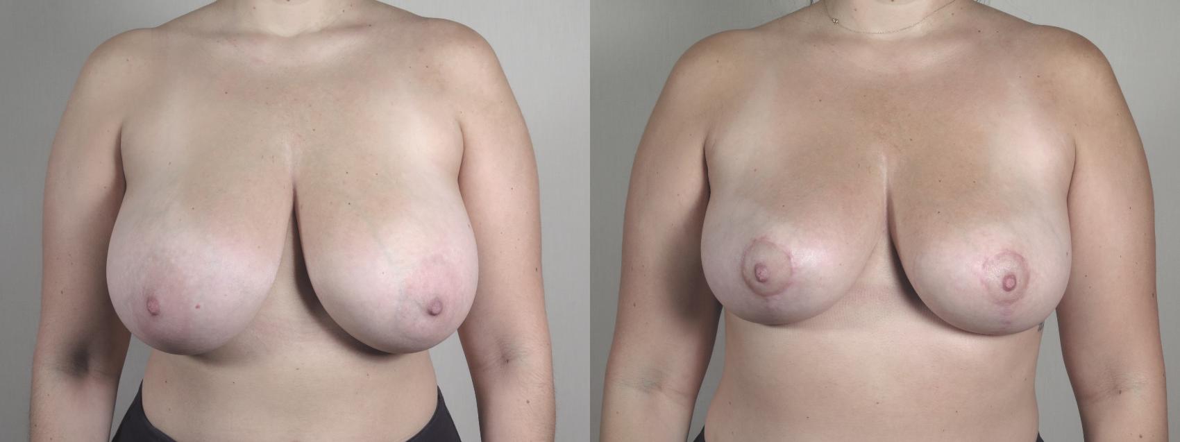 Breast Reduction Case 1475 Before & After Front | Paramus, New Jersey | Parker Center for Plastic Surgery