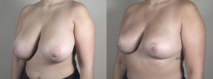 Breast Reduction Case 1475 Before & After Left Side | Paramus, New Jersey | Parker Center for Plastic Surgery