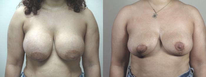 Breast Reduction Case 1477 Before & After Front | Paramus, New Jersey | Parker Center for Plastic Surgery