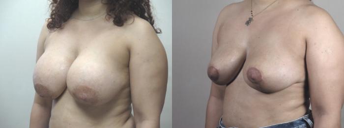 Breast Reduction Case 1477 Before & After Left Oblique | Paramus, New Jersey | Parker Center for Plastic Surgery