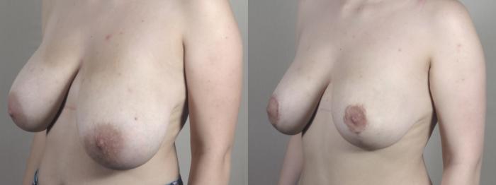 Breast Reduction Case 1478 Before & After Left Oblique | Paramus, New Jersey | Parker Center for Plastic Surgery