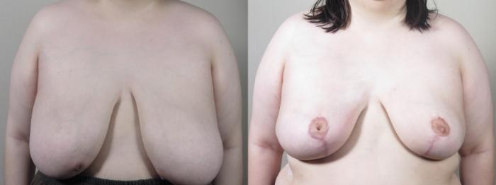 Breast Reduction Case 1527 Before & After Front | Paramus, New Jersey | Parker Center for Plastic Surgery