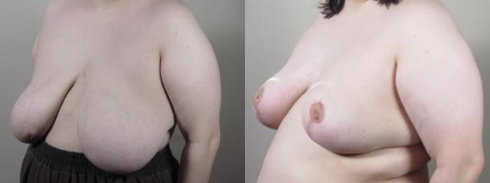 Breast Reduction Case 1527 Before & After Left Oblique | Paramus, New Jersey | Parker Center for Plastic Surgery