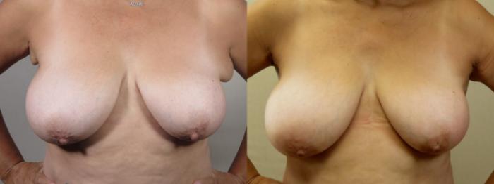 Breast Reduction Case 1545 Before & After front 2  | Paramus, New Jersey | Parker Center for Plastic Surgery