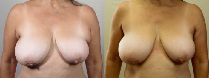 Breast Reduction Case 1545 Before & After Left Side | Paramus, New Jersey | Parker Center for Plastic Surgery