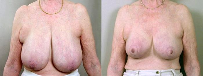 Breast Reduction Case 504 Before & After View #1 | Paramus, New Jersey | Parker Center for Plastic Surgery