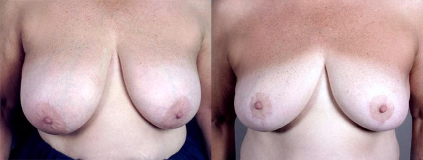 Breast Reduction Case 509 Before & After View #1 | Paramus, New Jersey | Parker Center for Plastic Surgery