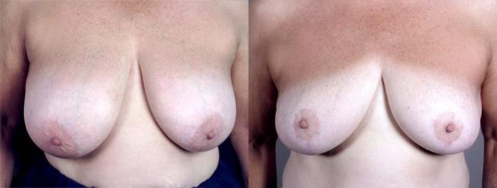 Breast Reduction Case 509 Before & After View #1 | Paramus, New Jersey | Parker Center for Plastic Surgery