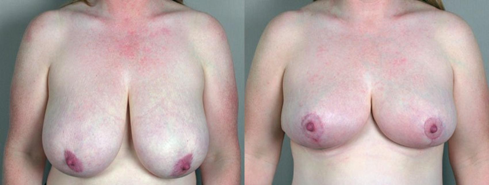 Breast Reduction Case 523 Before & After View #1 | Paramus, NJ | Parker Center for Plastic Surgery