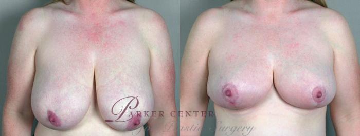 Breast Reduction Case 523 Before & After View #1 | Paramus, NJ | Parker Center for Plastic Surgery