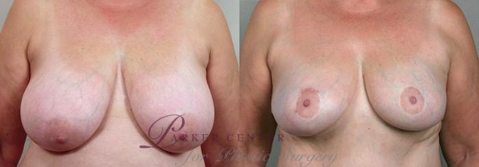 Breast Reduction Case 524 Before & After View #1 | Paramus, NJ | Parker Center for Plastic Surgery