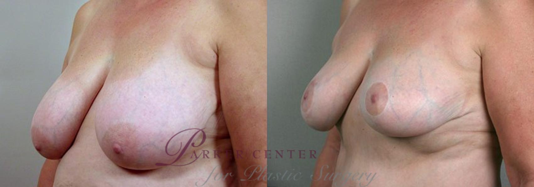 Breast Reduction Case 524 Before & After View #2 | Paramus, NJ | Parker Center for Plastic Surgery
