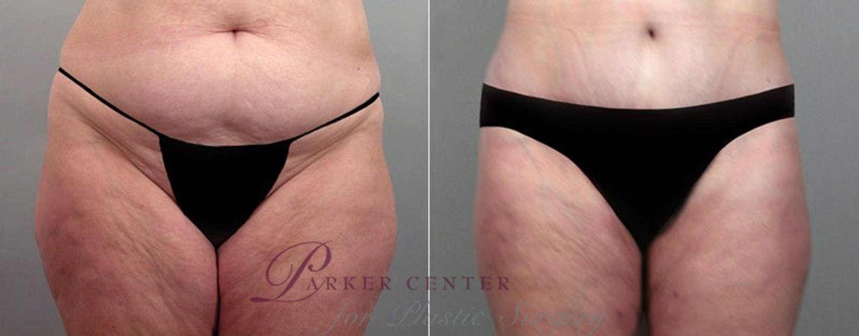 Breast Reduction Case 524 Before & After View #3 | Paramus, NJ | Parker Center for Plastic Surgery
