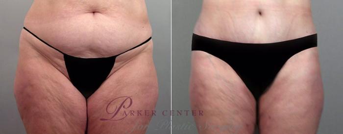 Mommy Makeover Case 524 Before & After View #3 | Paramus, NJ | Parker Center for Plastic Surgery