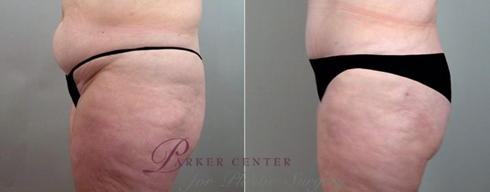 Breast Reduction Case 524 Before & After View #4 | Paramus, NJ | Parker Center for Plastic Surgery