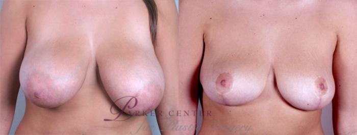 Breast Reduction Case 525 Before & After View #1 | Paramus, NJ | Parker Center for Plastic Surgery