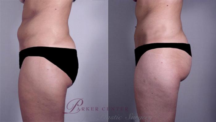 Breast Reduction Case 525 Before & After View #3 | Paramus, NJ | Parker Center for Plastic Surgery