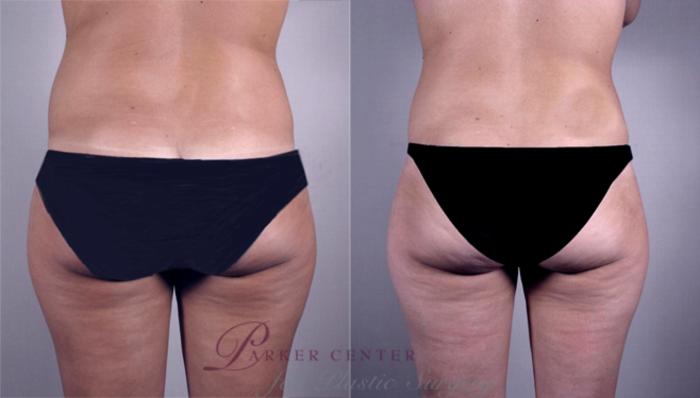Breast Reduction Case 525 Before & After View #4 | Paramus, NJ | Parker Center for Plastic Surgery